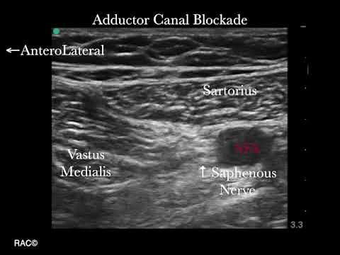 Ultrasound Guided Adductor Canal Block