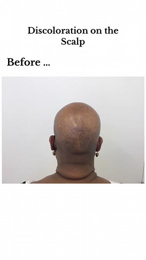 How to Treat Dark Spots and Discoloration on a Bald Scalp