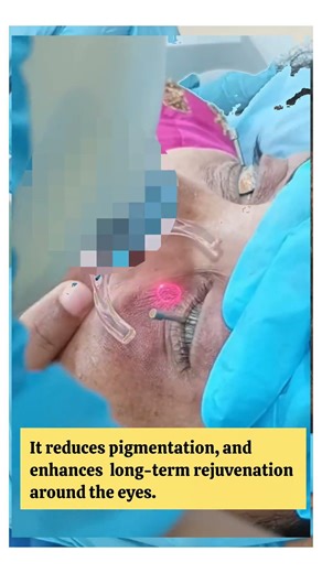 Eye Rejuvenation with Botox and Periocular co2 laser #bestskincare #skincare #darkcircles