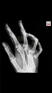 📎 Deep Transverse Metacarpal Ligament Anatomy & Function #anatomy #meded #ortho #medicaleducation