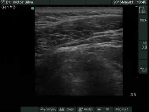 Trigger point injection - Ultrasound guided