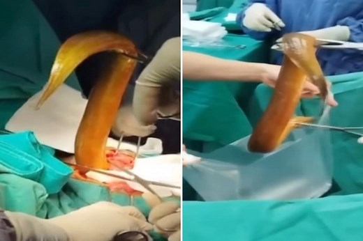 Live 2-foot eel chews through man’s intestines after he put it up his anus