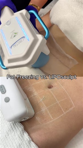 Fat Freezing vs LIPOsculpt: Let's talk about these two leading body sculpting treatments! Fat Freezing targets and eliminates stubborn fat through precision cooling, reduce stubborn pockets of fat that are resistant to diet and exercise. Complementing this, LIPOsculpt combines dual-action HIFU technology to both destroy fat, tighten skin and reduce the appearance of cellulite—offering a unique 2-in-1 treatment. Available now in Sydney, these treatments complement each other perfectly—reduce fat