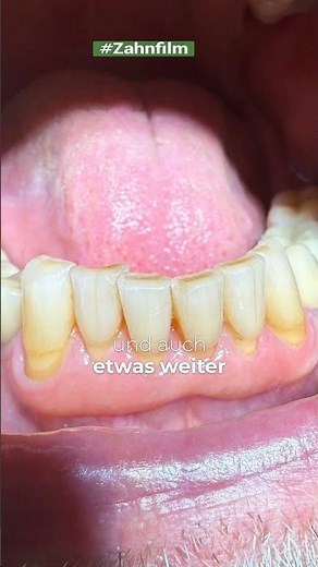 Receding gums! You're brushing wrong.