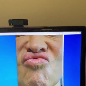 Orange Peel Chin. Wrinkled or Dimpled Chin and Botox