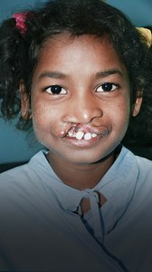 Operation Smile provides free cleft surgeries that transform children's lives in as few as 45 minutes. | Operation Smile