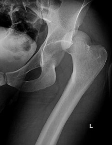 Hip Dislocation
