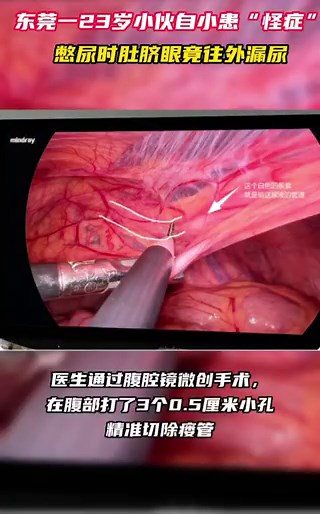 东莞23岁小伙一憋尿肚脐眼就漏尿东莞23岁的小肖自出生就有个难以启齿的秘密：只要憋尿，肚脐就会渗出泛黄液体，还带着刺鼻异味，严重时浸湿衣物，尴尬不已。在医院检查后，他确诊为脐尿管窦道伴感染，还存在癌变风险。所幸，医生通过腹腔镜微创手术，在其腹部打了3个0.5厘米小孔，精准切除瘘管。术后，小肖恢复良好，很快出院。医生提醒：脐尿管瘘如果长期不治疗，残留的脐尿管组织有癌变的可能，应尽早手术治疗，避免延误病情！