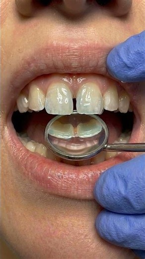 No Braces… Perfect Smile in Seconds ✨ #dentist #satisfying #asmr