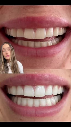 Get White Teeth with Gem Whitening Pen and Toothpaste