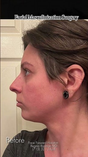 Facial Masculinization| Facial Plastic Surgery| Regina Rodman MD