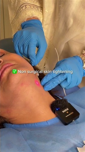 Endolift melts fat & tightens skin simultaneously - sculpting a sharper, more defined jawline
