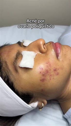 Acné y Síndrome de Ovario Poliquístico: Preguntas Frecuentes