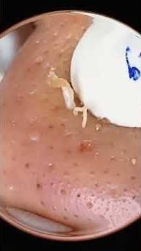 Extracción de puntos negros en la nariz 👃✨ | Limpieza rápida #extraccióndepuntosnegros