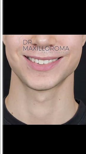 How to widen and define the jaw during bimax or double jaw surgery #looxmaxxing #surgerytiktok #surg