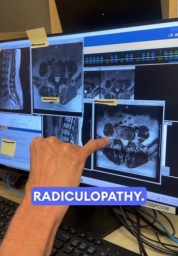 The art of diagnosis combines science, judgement, skill, and experience. It takes years to master. With decades in the field, Dr. Larson has developed a talent for for bringing simplicity to the once complex. He has an eye for catching what is often missed. When a radiologist overlooks a clinically relevant finding not once, but twice, it’s often only the surgeon who will push through the ridiculous insurance hurdle created by this “normal” reading in order for a patient to get the care they nee