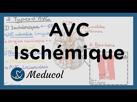 AVC ischémique: causes, embolie cérébrale, AVC thrombose et AVC jonctionnel