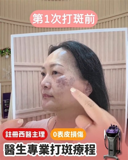 超快剪左條精華片 香港註冊西醫主理👩🏻‍⚕專業可靠治療團隊👩‍👩‍👧‍👦絕對安心💯 位處尖沙咀美麗華廣場佔地3000呎🏢 專業打斑-紫鑽雙波長激光 YanYan已經12月已經做左第6次打斑療程 同7月未做時相比，效果非常明顯及改善左好多 兩星期前Doris都做左，佢面上的印淡左好多同白淨左 今團我強烈建議大家買埋德國專利 =SEYO水光儀療程 做完紫鑽 SEYO效果更加好 香港註冊西醫主理👩🏻‍⚕專業打斑-紫鑽雙波長激光 #DS1812 📍單次 $880 ❌原價單次$2980 📍3次 $1980 (平均$660/次) ❌原價3次$7980 ‼包醫生診金 ‼包皮膚分析 ✅送治療師全面嫩膚步驟 首50名客人‼️由1月5日開始聯絡預約‼️ 1月15日-農曆新年前 進行療程 專業打斑-紫鑽雙波長激光網站下單👇🏻 www.lemonfashion.com.hk/products/醫生專業打斑-紫鑽雙波長激光 SEYO網站下單👇🏻 www.lemonfashion.com.hk/products/鉑金宇宙版-超聲炮 🎦Heidi Doris 直播介紹👇🏻 ht