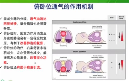 重症医学中 俯卧位通气站位与操作