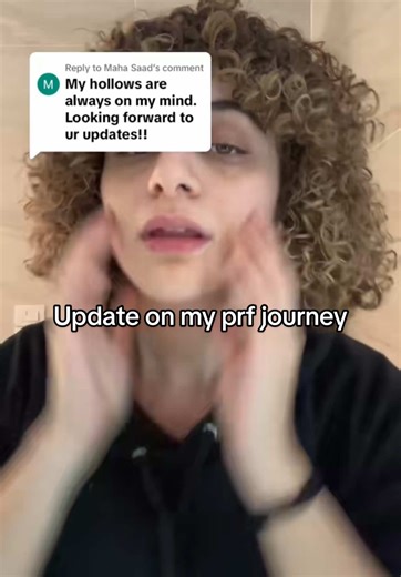 Understanding PRF Treatment for Dark Circles