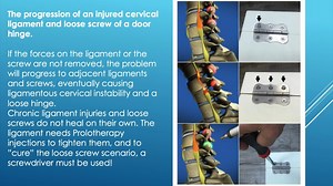 Post Concussion Syndrome! Many athletes (as well as non-athletes) suffer from this condition - and it goes underdiagnosed. Dr. Hauser discusses this timely topic in detail in this video. Some of our patients report that they have suffered 4, 6, 8, 10 or more concussions over their lives. This is not good for the neck, the brain, or the cervical curve. If you are having symptoms you feel might be related to concussions you have suffered in the past, call now! We want to help! See the full video b