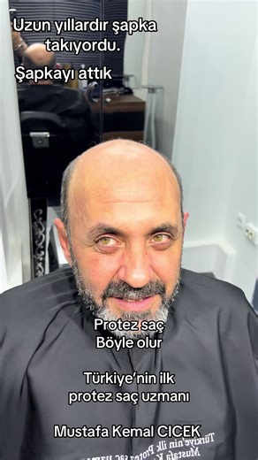 Protez Saç Kullanımı ve İpuçları