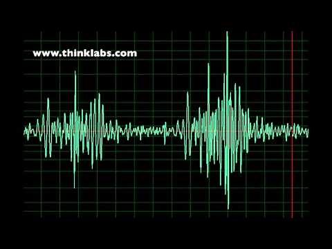 Patent Ductus Arteriosus- normal speed