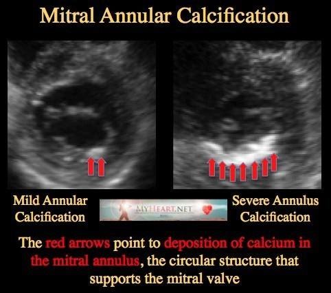 Heart Matters on Instagram: "Mitral Annular Calcification (MAC) 》Definition A chronic, degenerative calcification of the fibrous mitral valve annulus, typically involving the posterior annulus. 》Epidemiology & Risk Factors ● Ageing (most important) ● Female sex ● Chronic kidney disease / dialysis ● Hypertension ● Diabetes mellitus ● Atherosclerosis ● Disorders of calcium–phosphate metabolism 》Pathophysiology ▪︎ Progressive fibro-calcific degeneration of the annulus ▪︎ Not a primary valve disease