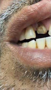 How To Fix A Broken Tooth.