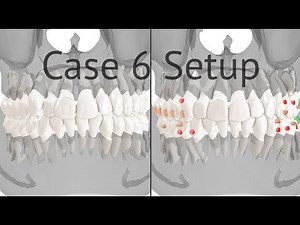 Maestro 3D aligners virtual setup: case 6, single-side distalization