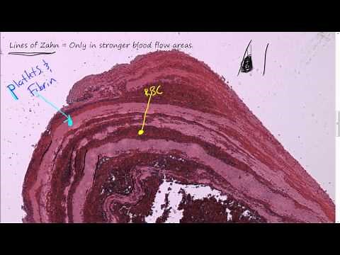 #57P - Morphology of Thrombi and blood clots, Review of heart blood flow path, embolus