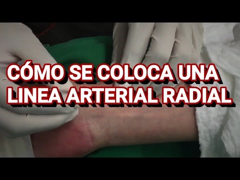 LINEA ARTERIAL RADIAL | COMO COLOCAR