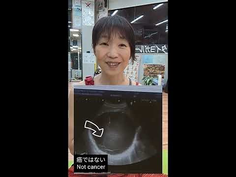 肝嚢胞13cmのオペ‪@reiko-ohnishi‬ #明日 #手術 #経皮的肝嚢胞内エタノール注入療法