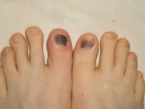 New Toenail Growth Process: 11 Months in 10 Seconds (No Audio)