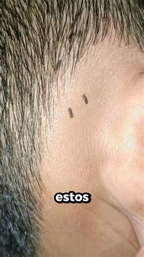 What would happen if you had lice?