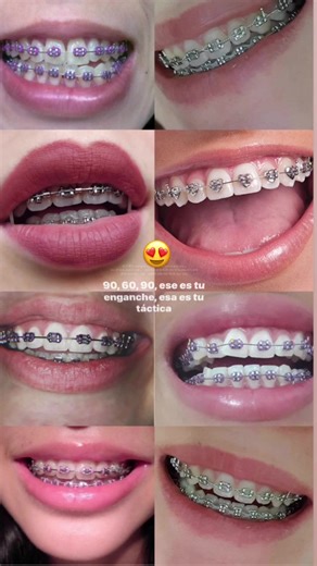 Todo sobre brackets: Edits, colocación y aplicación