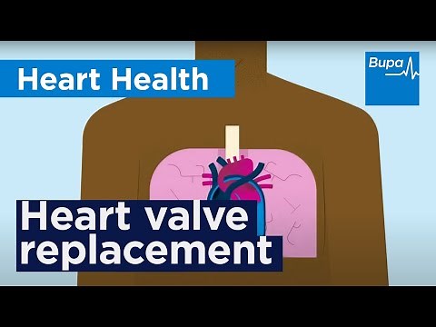 How is a heart valve replacement done | Bupa Health