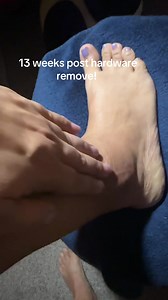 My Journey of Recovery: 4 Years After Ankle Surgery