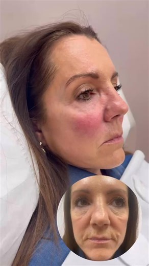 Cheek Filler Results ✨ 2ml of facial filler was used to restore lost volume in the cheeks. By adding 1ml to each side it’s created a subtle lift to the face, giving a brighter, fresher appearance. Any initial redness is normal and will subside after treatment. Full aftercare information and aftercare bag included with all treatments. Ready for your own glow up? 📩 Book a consultation or give us a message to discuss your goals and suitability. 🖥️ Book online via the link in our bio. 📍 1a Prince