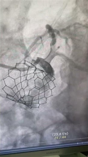Post TAVR PCI - balloon assisted extension catheter engagement / dRCA, pLAD lesion