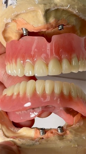 Metal mesh reinforced hybrid denture for Dr. Todd Sheffler in New Hampshire