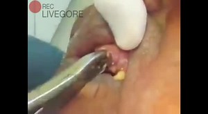 Doctor Clean Up Maggots From Patient Eye