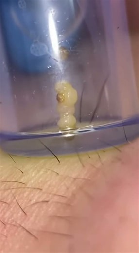 Most satisfying blackhead vacuum extraction EVER!