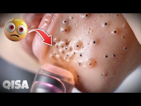 Unbelievable Pimple Popping Video | Huge Blackhead Extraction 😱😱