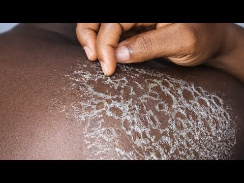 Extreme Dry Back Flakes Removal