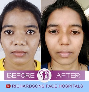 4 Things You Must Know About Tip Refinement Rhinoplasty In India – Richardson's Plastic Surgery Hospitals