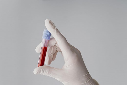 Urée : basse, élevée, quelles sont les normes ?