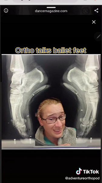 Exploring Ballet Feet Injuries: Understanding the Orthopedic Perspective