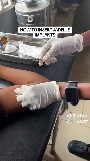 How to Insert Jadelle Implants - Step-by-Step Guide