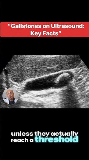 When to Remove Gallstones: Asymptomatic vs. Symptomatic Cases